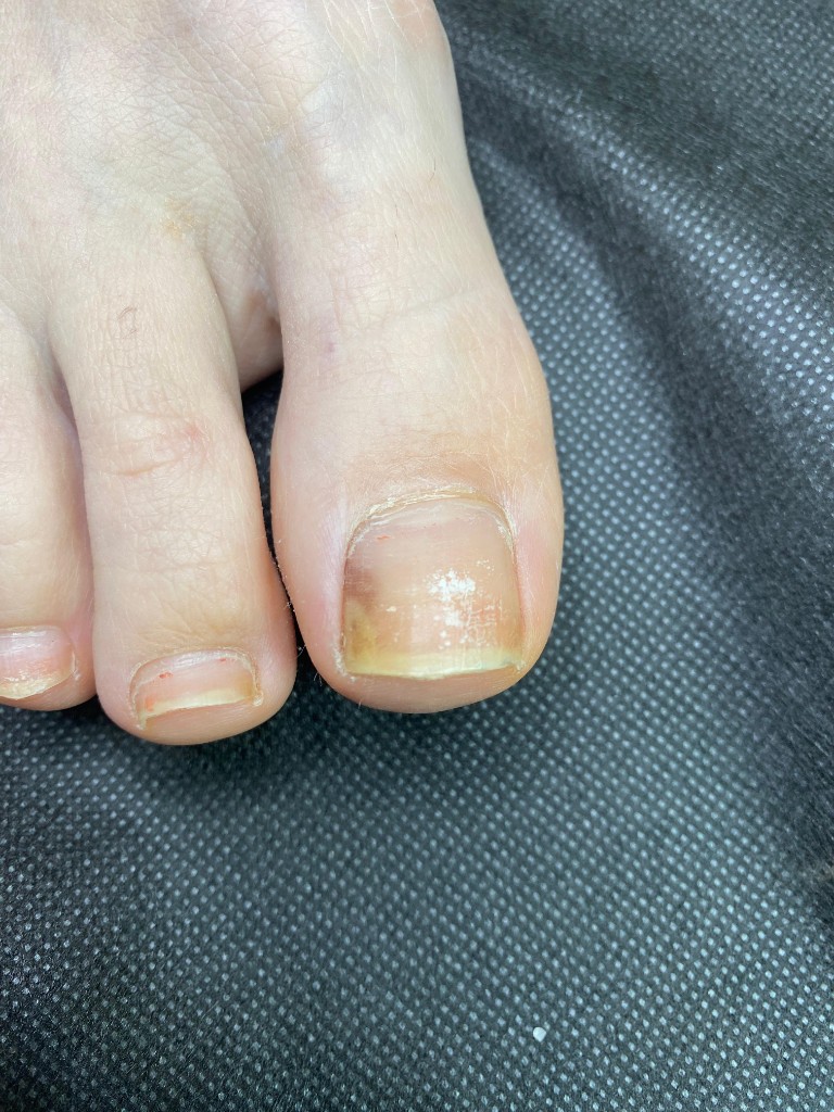 Изменение цвета и отслоение от ложа