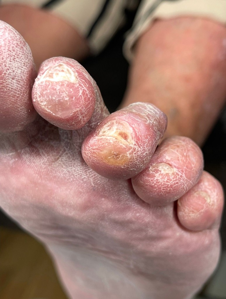 Гиперкератоз, сухость и утолщения на подошвенной поверхности стопы — пример состояния, требующего профессионального ухода